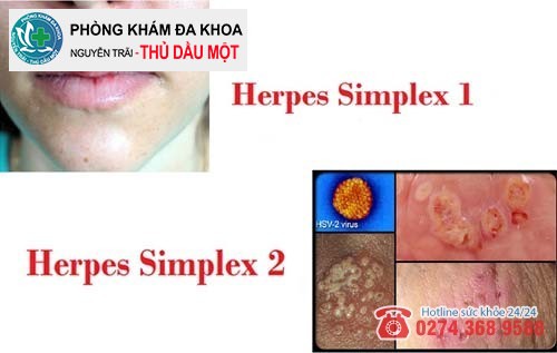 Virus HPV gây bệnh Herpes nam có hai loại chính
