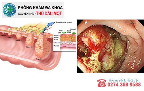 Rò hậu môn không được điều trị có nguy cơ mắc ung thư trực tràng cao