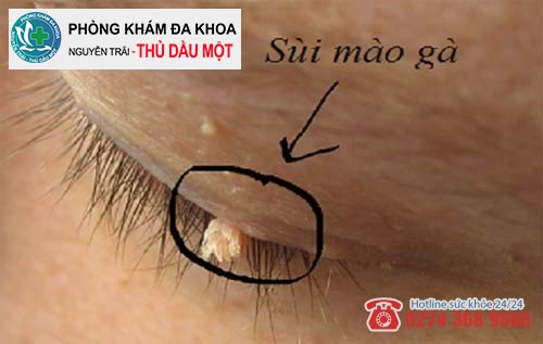 Các u nhú phát triển mạnh và liên kết với nhau thành từng chùm