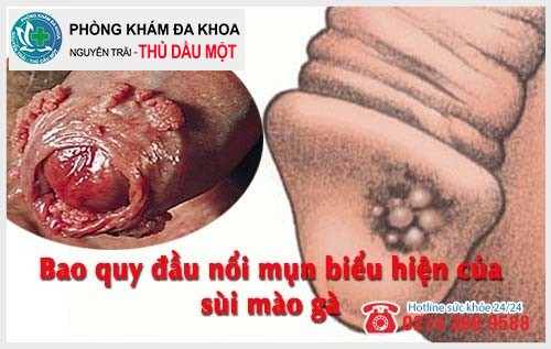 Bao quy đầu nổi mụn có thể là bệnh sùi mào gà