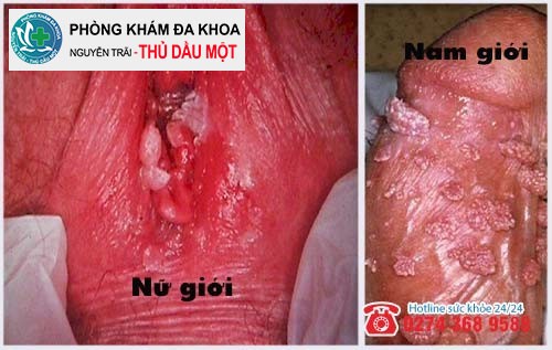 Sùi mào gà căn bệnh nguy hiểm