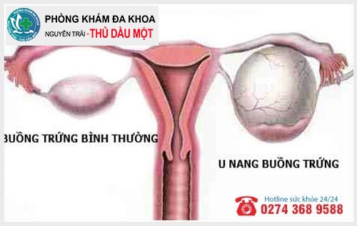 Phân loại u nang buồng trứng