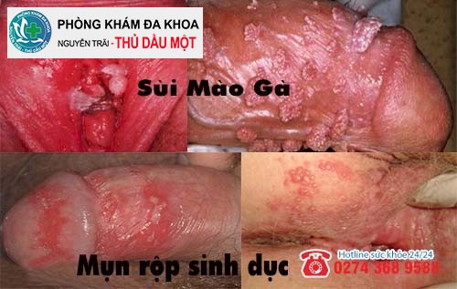 Các bệnh xã hội gây ngứa vùng kín