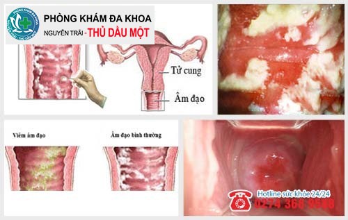 Bệnh Viêm Âm Đạo