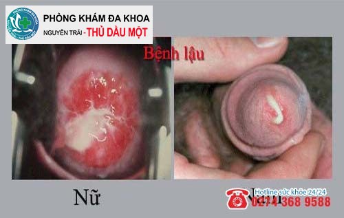 Nhận biết bệnh lậu mãn tính