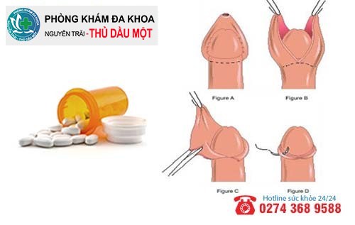 Cách hỗ trợ chữa trị nấm bao quy đầu hiệu quả　