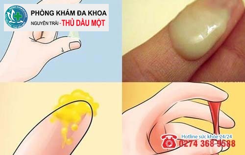 Khí hư bất thường có gây vô sinh không?