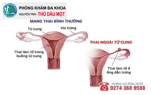 Mang thai ngoài tử cung