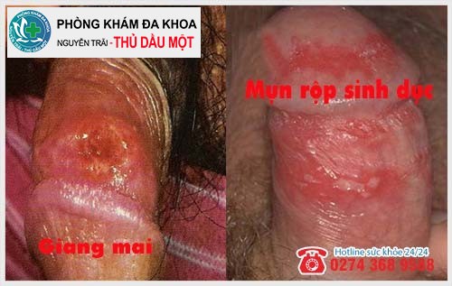 Loét dương vật có thể là bệnh xã hội nguy hiểm