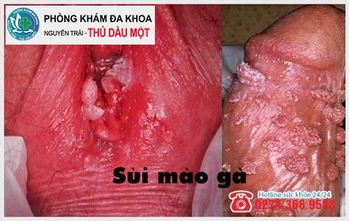 Mụn tại vùng kín nam và nữ là sùi mào gà