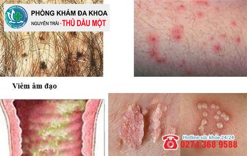 Ngứa vùng kín nữ - dấu hiệu cảnh báo nhiều bệnh nguy hiểm chớ nên xem thường