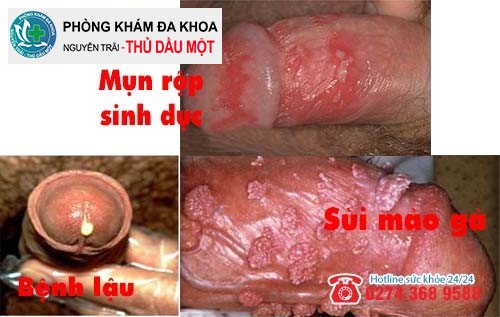 Ngứa dương vật có thể do bệnh xã hội