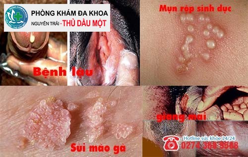 Các bệnh xã hội gây rát vùng kín