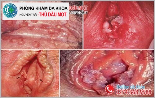 Bệnh có thể vỡ ra, chảy máu