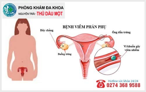 Bệnh viêm phần phụ ở phụ nữ