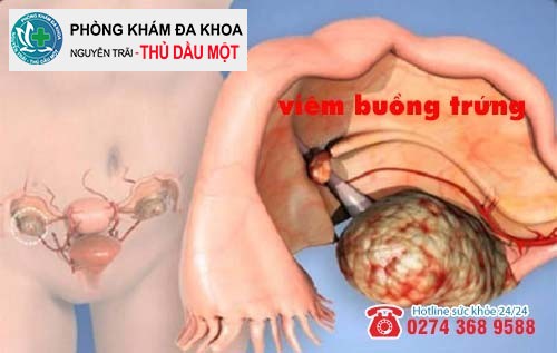 Viêm buồng trứng bệnh phụ khoa nguy hiểm