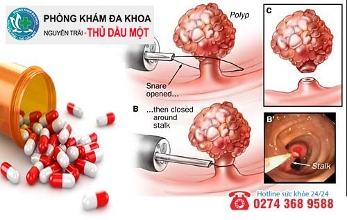 Phương pháp hỗ trợ điều trị polyp đại tràng hiệu quả