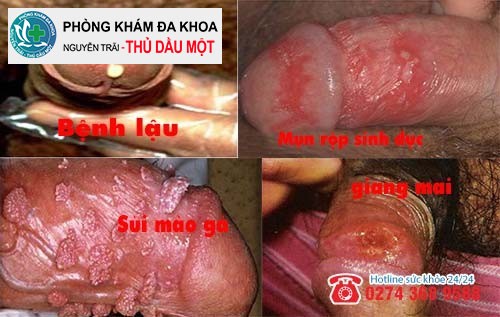 Sưng lỗ sáo là biểu hiện của các bệnh xã hội nào?