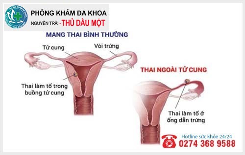 thai chưa vào tử cung được xác định do 2 nguyên nhân