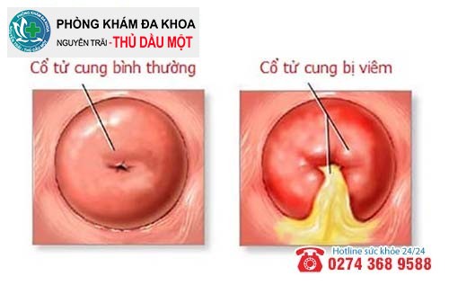 Viêm cổ tử cung gây nhiều tác hại khôn lường đối với nữ giới