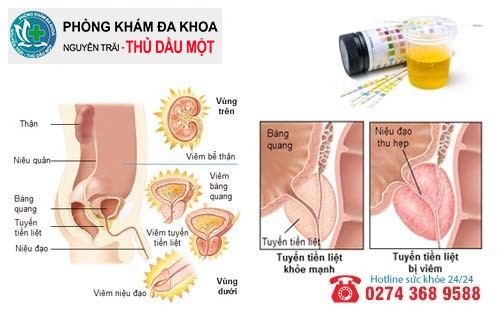 Xét nghiệm nước tiểu phát hiện bệnh gì của nam giới?